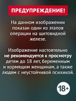 Один из этапов операции на щитовидной железе